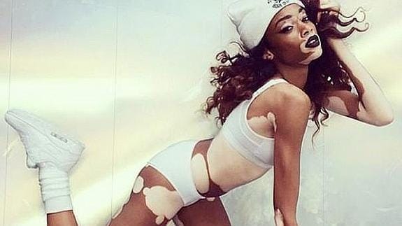 Winnie Harlow, la primera modelo con vitíligo | El Correo