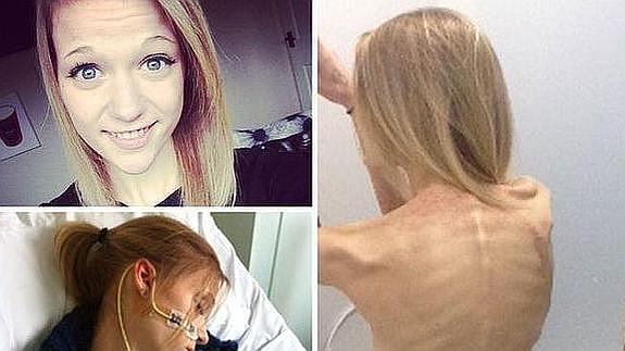 Una joven cae en la anorexia inspirada en selfies que muestran la enfermedad