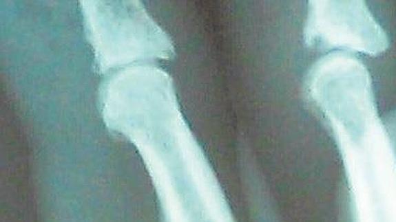 Radiografía que muestra la fractura del dedo de Irujo.