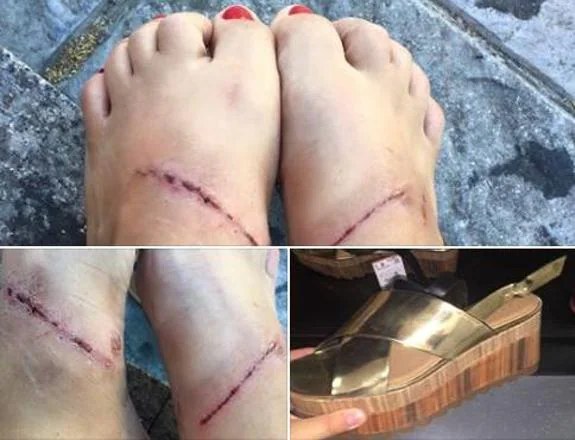 Las heridas por unas sandalias de Zara revolucionan las redes sociales | El Correo