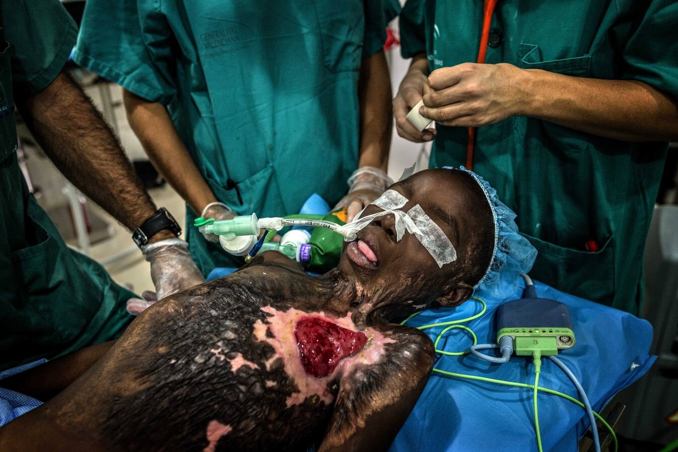 Una niña con quemaduras severas está a punto de ser operada por médicos de la ONGD española OASIS en el bloque quirúrgico construido en el Centro Don Orione de Bombuaka. (Foto: Antonio Aragón)