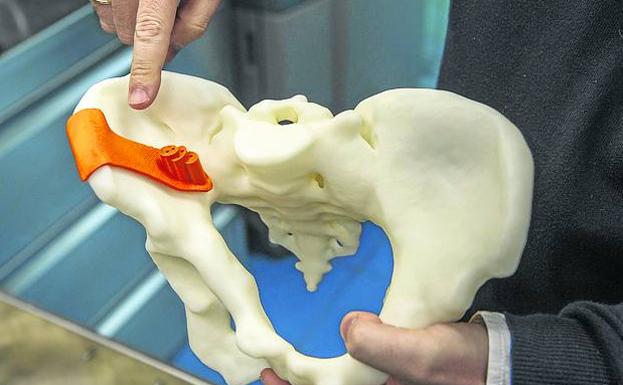 A través de un escáner se diseña en 3D para imprimir esta pelvis con un problema de rotación.