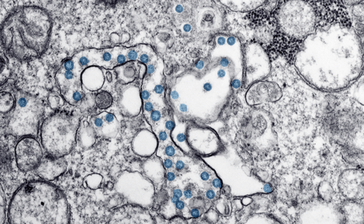 Imagen de microscopía electrónica de transmisión del primer caso de Covid-19 detectado en EE UU. Se observan las partículas esféricas virales, coloreadas en azul, colonizando orgánulos funcionales del citoplasma de una célula infectada. 