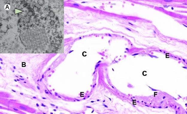 Figura 3. Imágenes de microscopía electrónica de transmisión (A), y microscopía óptica, tinción H&E, de corte histológico de músculo cardíaco (B-H), en paciente con Covid-19 fallecido por infarto de miocardio. El corte procede del músculo cardíaco conservado, no afectado por el infarto. A: detalle de porción citoplásmica de célula endotelial cargada de virus. Los agregados de partículas virales (flecha), se muestran como círculos densos con centro claro. B: estroma conectivo laxo edematoso de músculo cardíaco, con vaso sanguíneo dilatado (C). D: células musculares cardíacas conservadas (cardiomiocitos). E: células endoteliales reactivas que tapizan el vaso, con restos de fibrina adheridos (F), y algunos linfocitos dispersos bajo el endotelio (G). H: hematíes dentro de la luz del vaso. El grado de endotelitis es mínimo, casi imperceptible en microscopía óptica. 