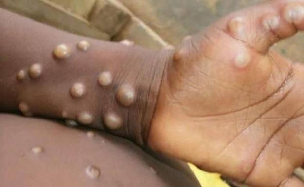 Suben a 18 los casos de viruela del mono en Cantabria