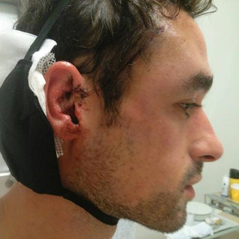 Alberto Mier, el jugador cántabro agredido, muestra las heridas sufridas en la oreja.
