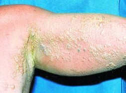 Ampollas producidas por un herpes.