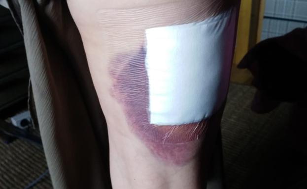 Hematoma como consecuencia del mordisco de la vecina que fue atacada en junio. 