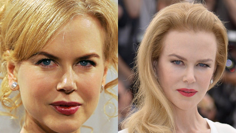 Nicole Kidman, otra de las víctimas de la cirugía.