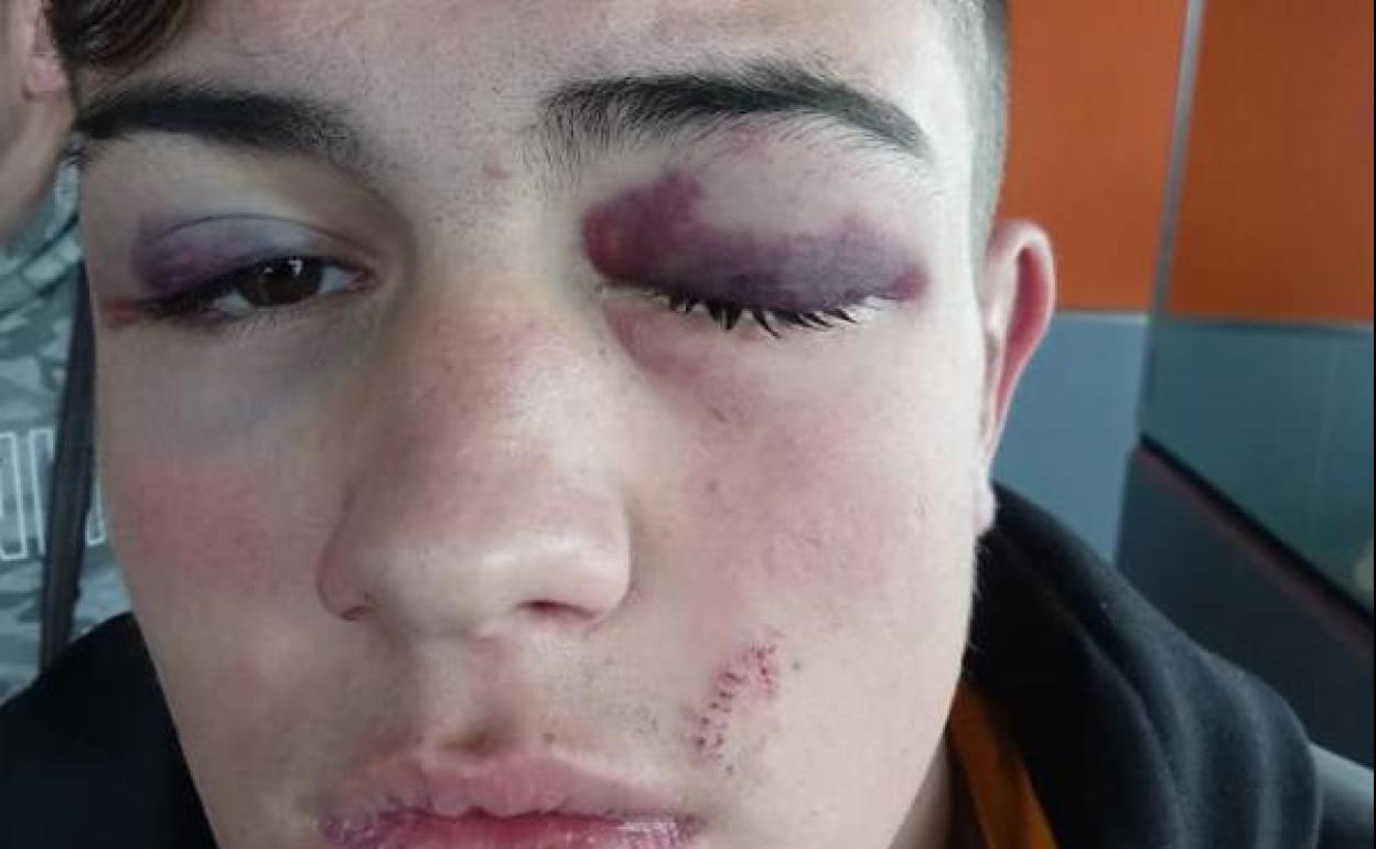 El joven de 17 años que sufrió la agresión el pasado martes en La Rosaleda.