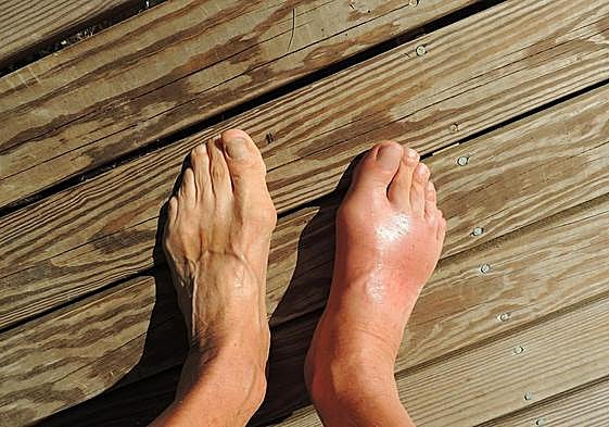 Imagen de archivo de un pie afectado por la retención de líquidos.
