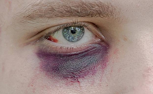 El ojo de Alexander. 