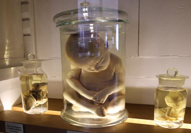 El feto de ocho meses que murio de hidrocefalia y está conservado en parafina en el Museo de Ciencia Naturales.