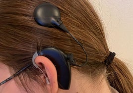 Implante coclear del oído izquierdo de Julia Montero.