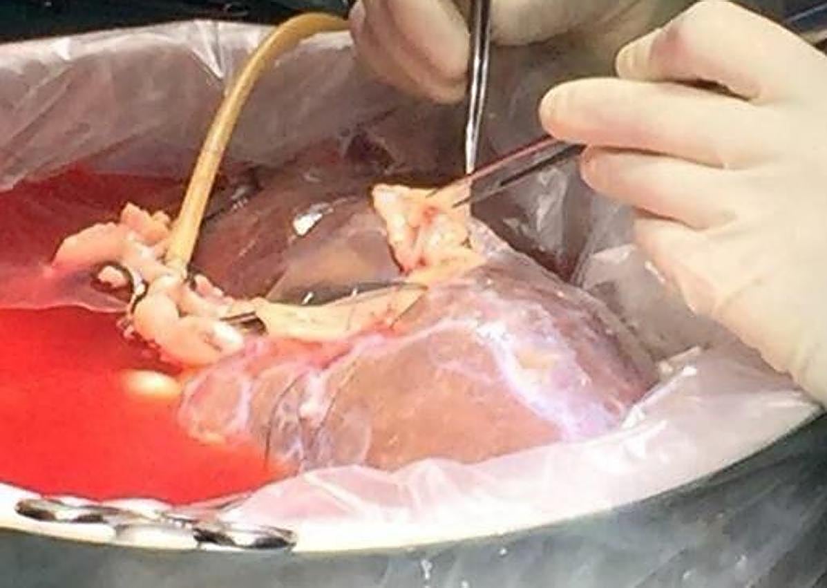 Imagen secundaria 1 - Trabajo en quirófano, manipulación previa al trasplante y zona quirúrgica del Clínico de Valladolid.