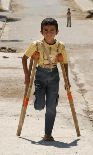 Un niño, mutilado por las minas antipersona. / Archivo
