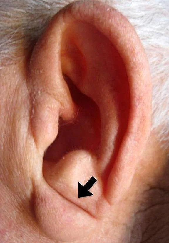 El pliegue diagonal del lóbulo de la oreja es un marcador de enfermedad cardiovascular 