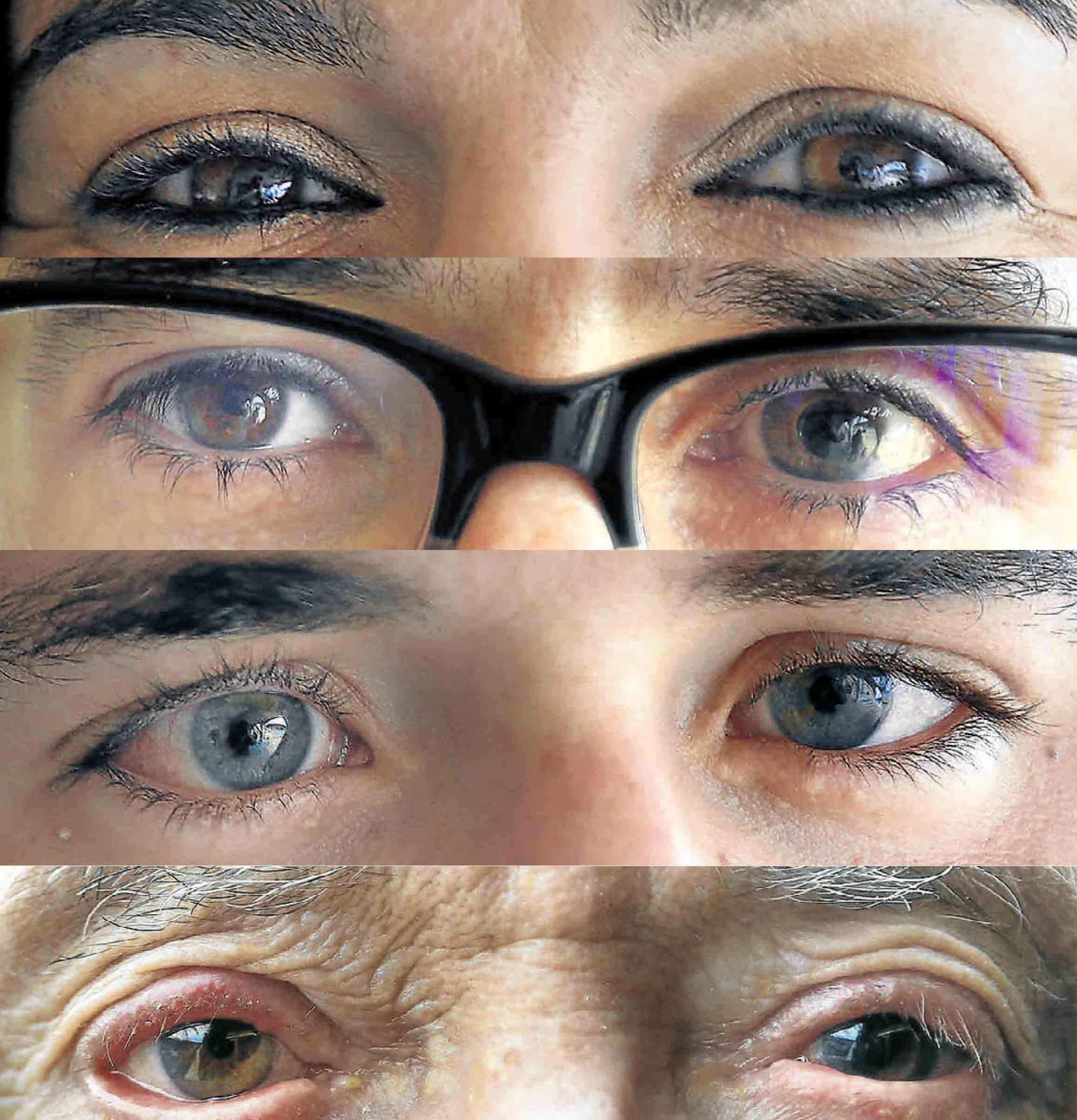 Cuatro de los afectados del País Vasco por la lesión en el nervio óptico.