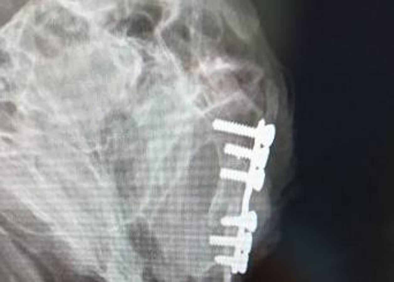 Radiografía en la que se aprecia la placa de osteosíntesis implantada.