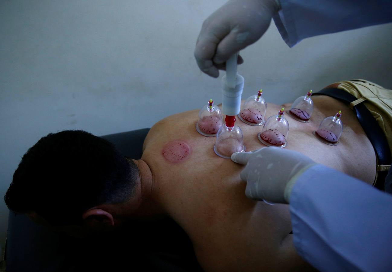 La terapia de ahuecamiento Hijama