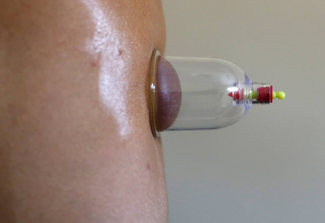 La terapia de ahuecamiento Hijama