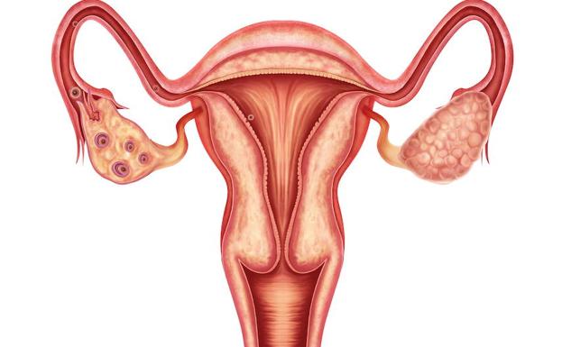 Un estudio pionero extremeño sobre el cáncer de ovario revela que el 16% es hereditario