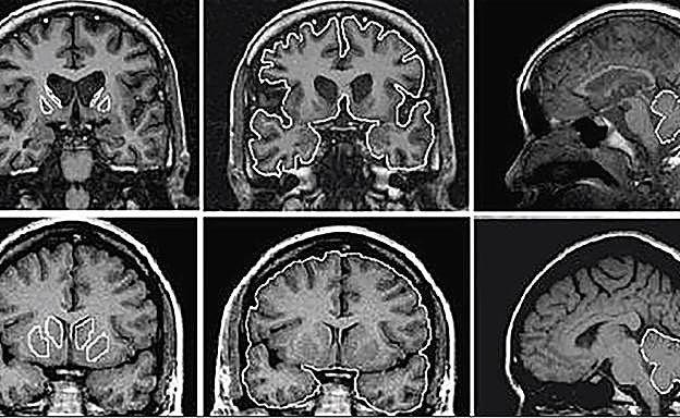 Imágenes de un cerebro afectado por la enfermedad de Huntington (arriba) y abajo, un cerebro sano.