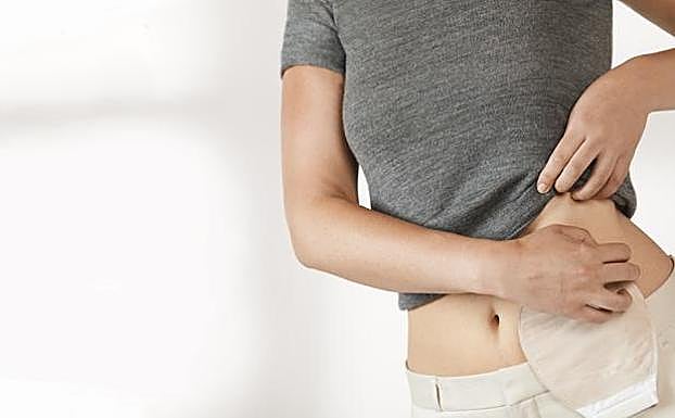 Reclaman al SES cuidados de Enfermería especializados para pacientes ostomizados