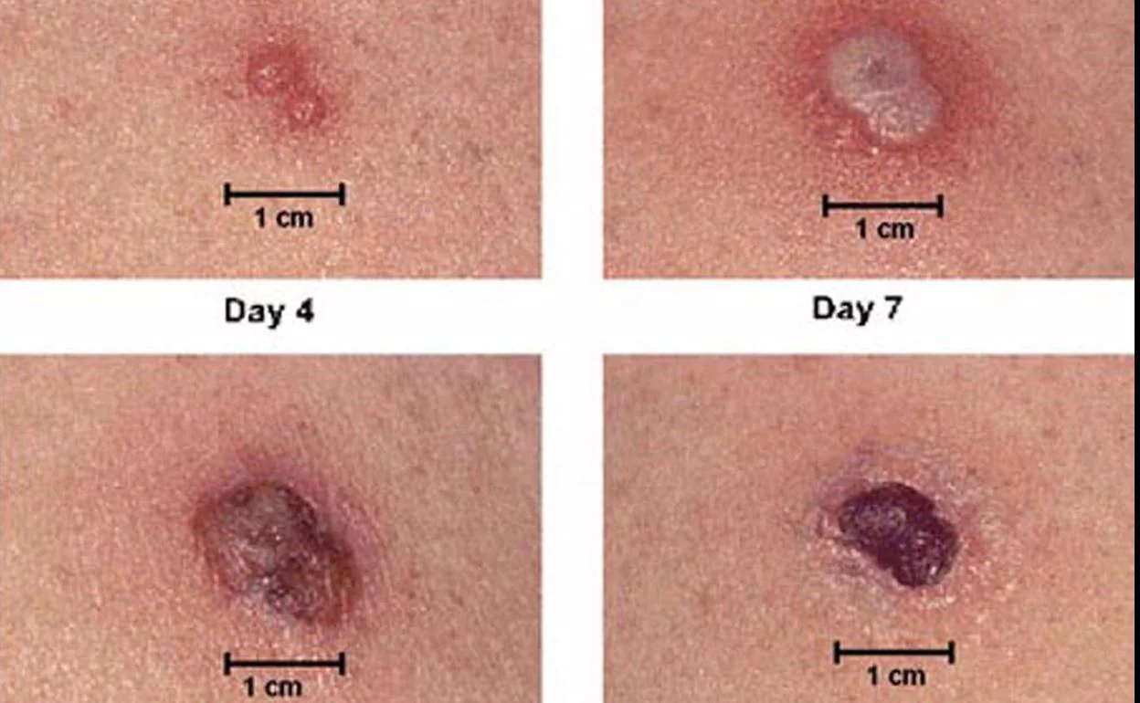 Imagen de reacción sobre la piel producida por la vacuna de la viruela humana.