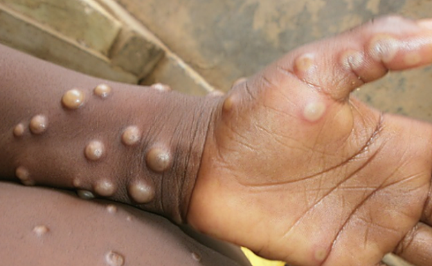 Extremadura registra el primer caso sospechoso de viruela del mono en una mujer