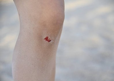 Imagen secundaria 1 - Golpes y heridas para poder jugar a vóley-playa