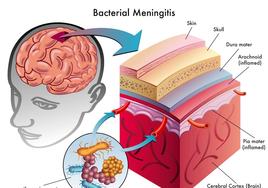 Todo lo que necesitas saber sobre la meningitis en niños: síntomas, prevención y tratamiento