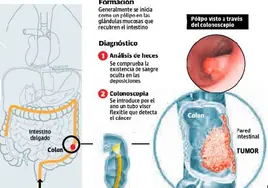En Extremadura se diagnosticaron 964 casos de cáncer de colon en 2023.