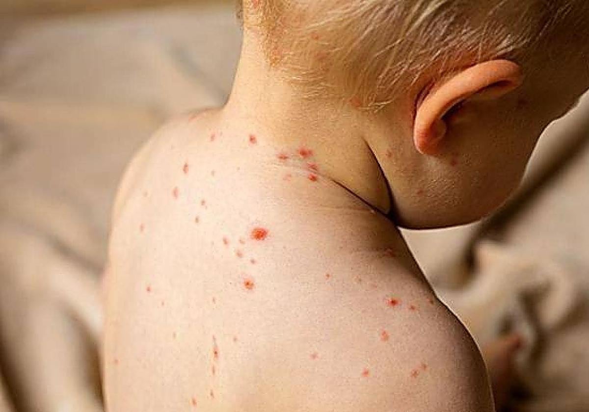 El SES recomienda la vacunación frente al sarampión a niños de 4 años tras diagnosticar tres casos