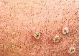 Extremadura ha notificado un caso de viruela del mono en el último mes y 34 desde 2022