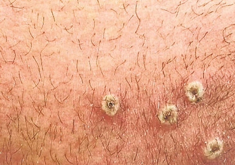 Extremadura ha notificado un caso de viruela del mono en el último mes y 34 desde 2022