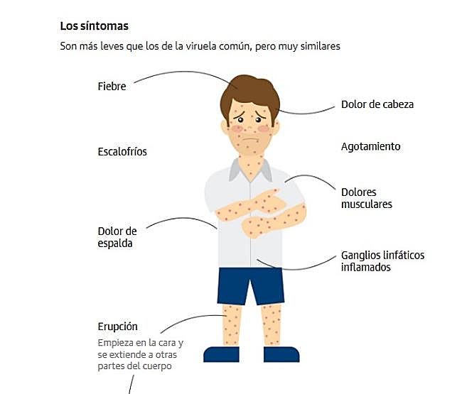 Síntomas de la viruela del mono.