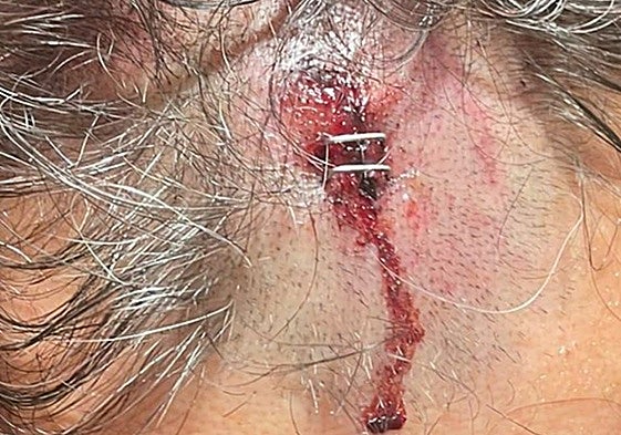 Herida en la cabeza de R.C., con dos grapas incrustadas.