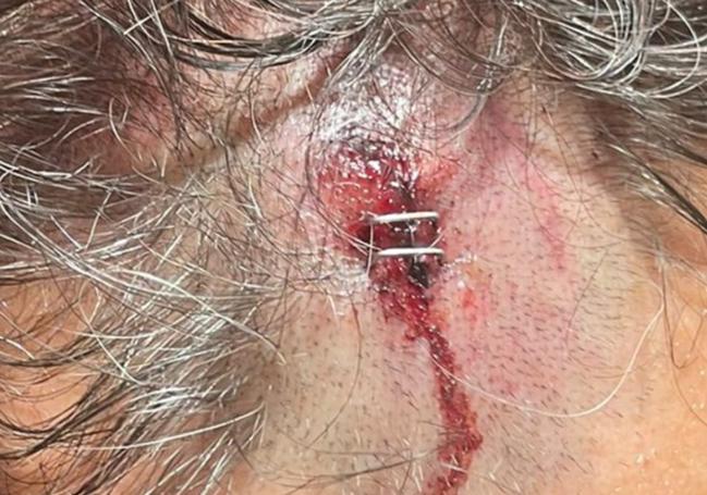 Herida que presentaba el marido de la segunda teniente de alcalde del Ayuntamiento de Sierra de Fuentes tras la agresión.