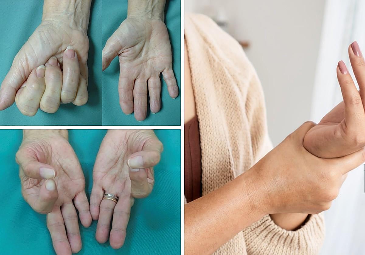 Juan González del Pino, especialista en artrosis de la mano: «Los tratamientos modernos pueden devolver la movilidad y eliminar el dolor»