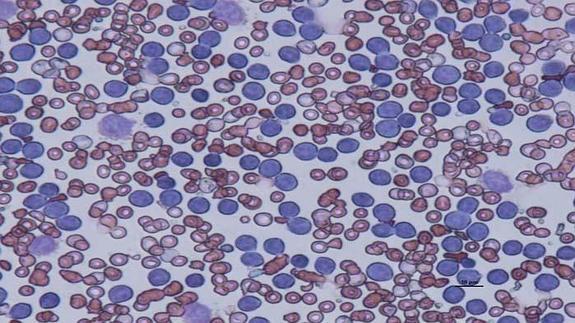 Imagen microscópica de un frotis de leucemia.