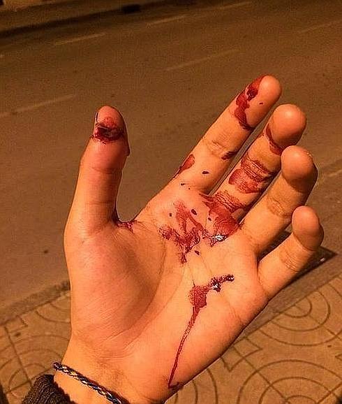 Detalle de la mano de uno de los jóvenes después de que el agresor le asestara un mordisco.