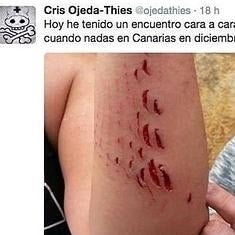 peores mordeduras de tiburón