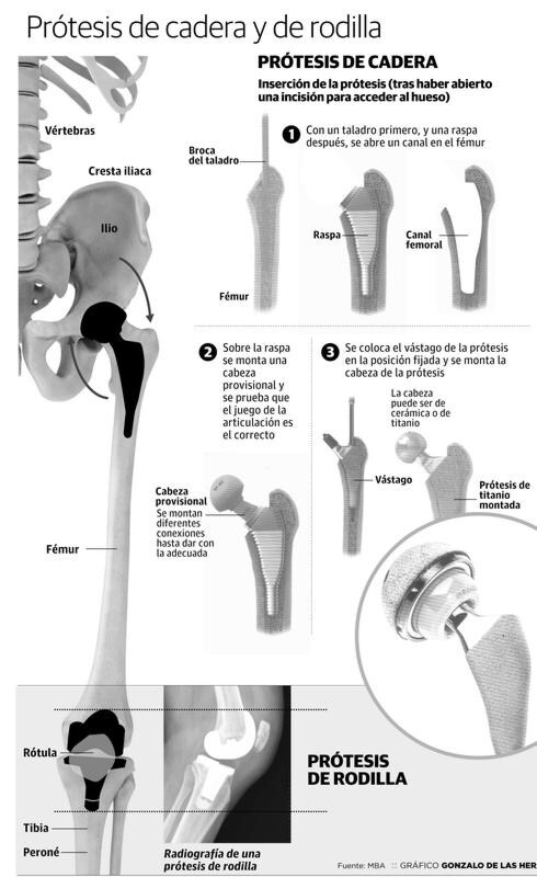 El envejecimiento dispara un 25% las operaciones de rodilla y cadera en Extremadura