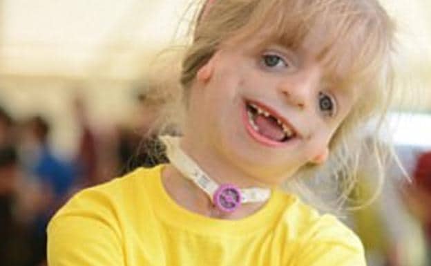 La dura historia de Maisie, la niña que se ha operado 29 veces el rostro