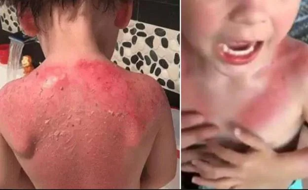 Un niño sufre graves quemaduras tras usar un protector solar de Peppa Pig