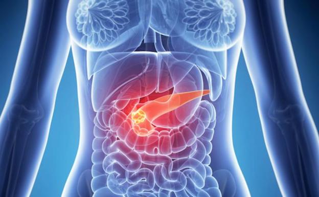 Las 4 cosas que notarás en tu cuerpo si tienes cáncer de páncreas