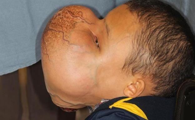 Muere Emanuel, el niño de 14 años al que extirparon un tumor facial de 4,5 kilos