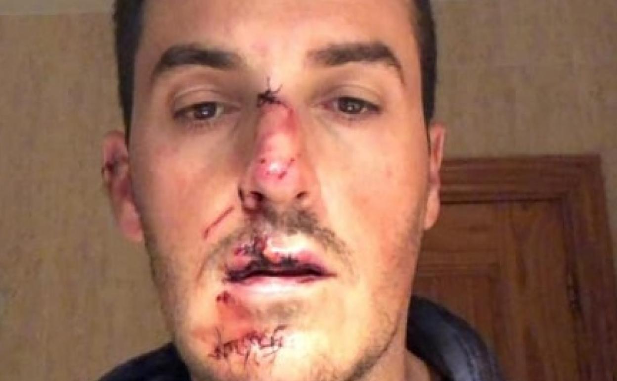 Albero Ruiz sufre una fractura de nariz y ha perdido cinco dientes por culpa de un atropello. 