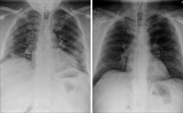 Imagen de rayos-X del tórax de una persona con Covid-19 (izquierda) y placa de un paciente que dio negativo en Covid-19 (derecha).